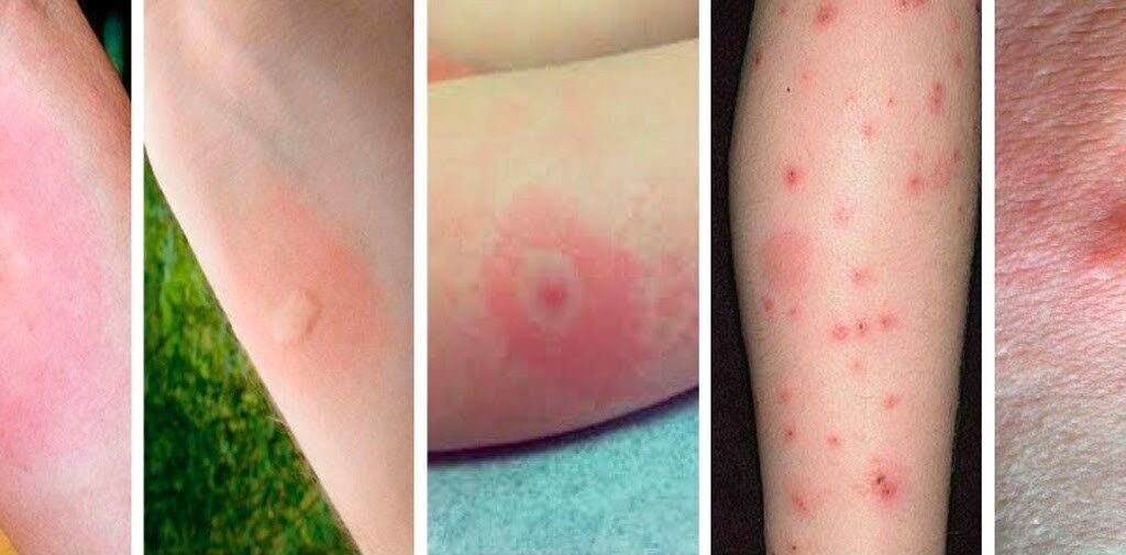 Battle of the Bites101: Fleas Bites Vs Mosquitoes Bites