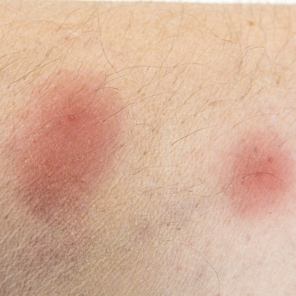 Bite Marks And Symptoms: Spider Vs Mosquito